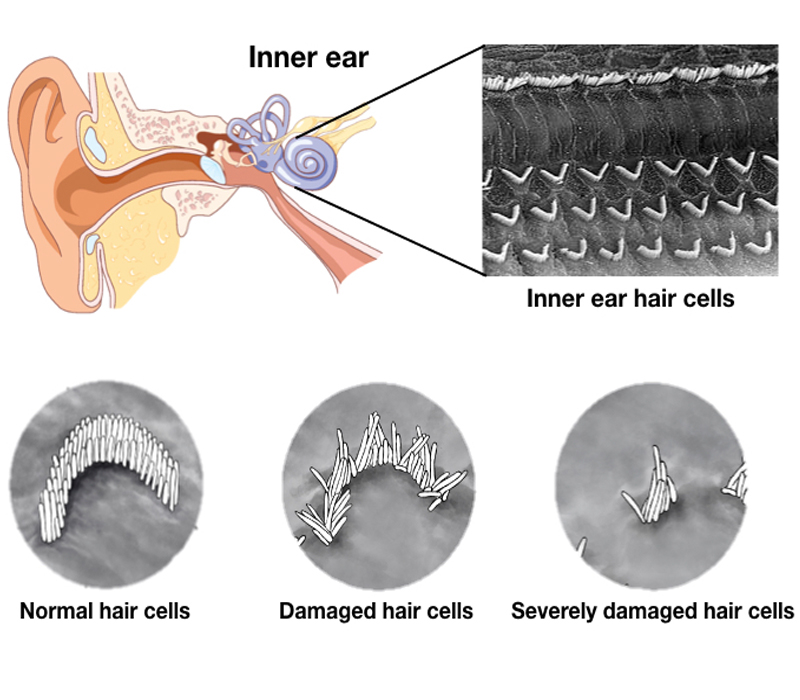 presbycusis Types of Hearing problem